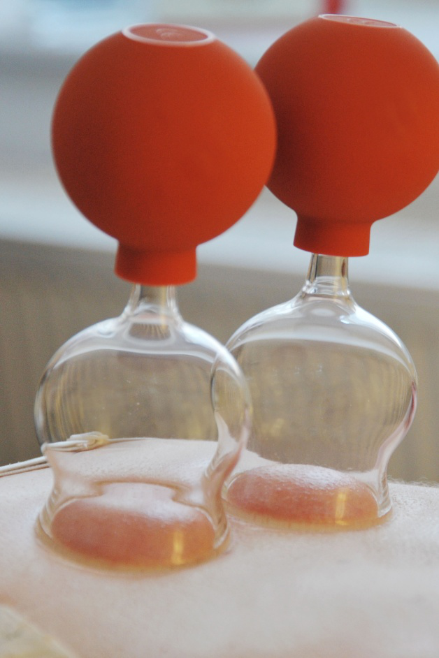 What Are the Benefits of Cupping Therapy