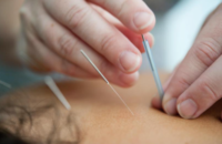 what you should know about acupuncture and herbal medicine, acupuncture, acupuncture needles, does acupuncture hurt, is acupuncture painful